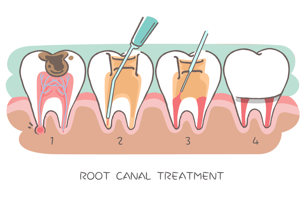 how much does a root canal cost without insurance