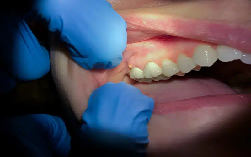how long until a tooth infection kills you