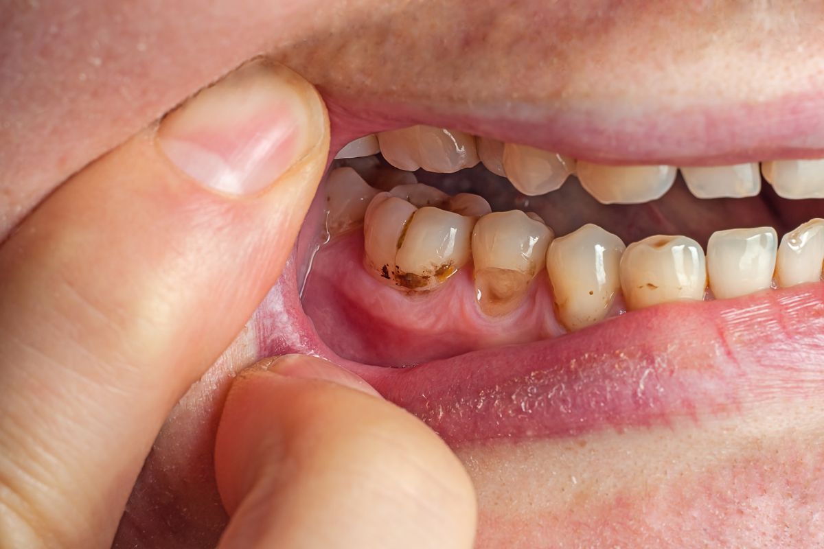 cavity on front tooth