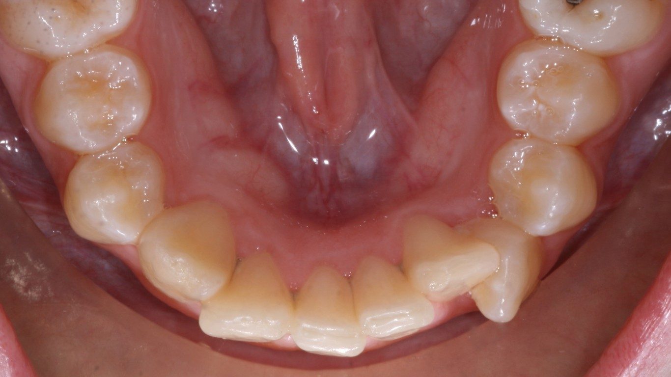 does everyone have wisdom teeth