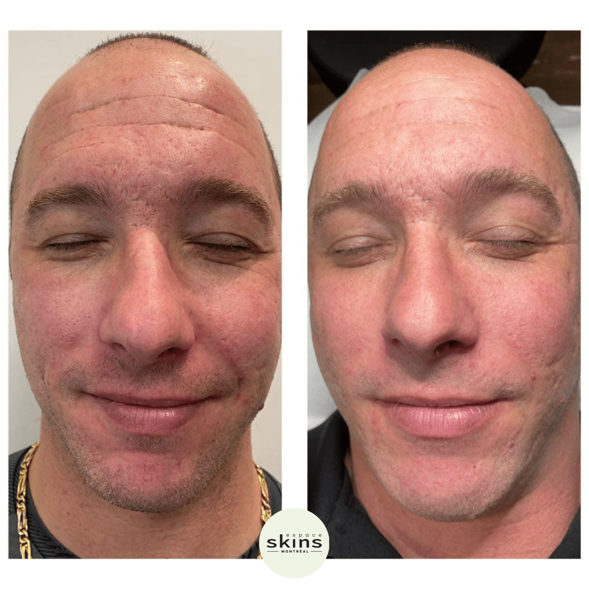 microneedling downtime