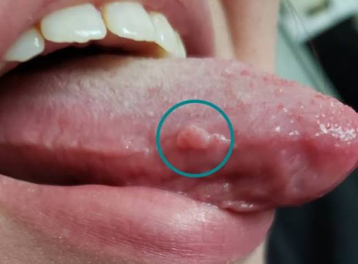 can you get a pimple on your tongue